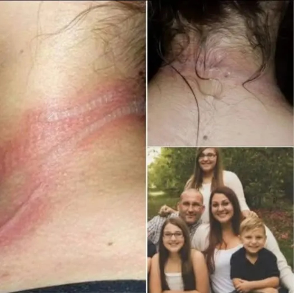 13-year-old girl left with horrific burns on her neck after using her cellphone while it was charging!