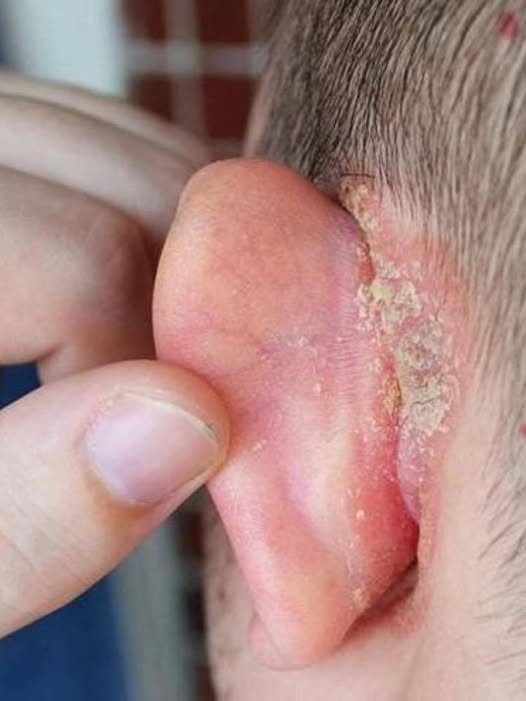 I noticed a strange patch of skin on my sons ear, and with his doctor appointment still a week away