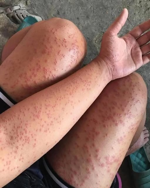 I Slept at my friends old apartment for a couple days noticed these weird bump – See more!